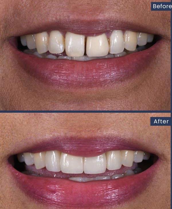 before and after cosmetic dental care at Mitten Family Dental