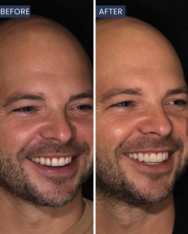 before and after patient's smile at Mitten Family Dental