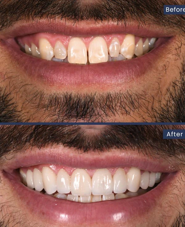 before and after smile makeover at Mitten Family Dental